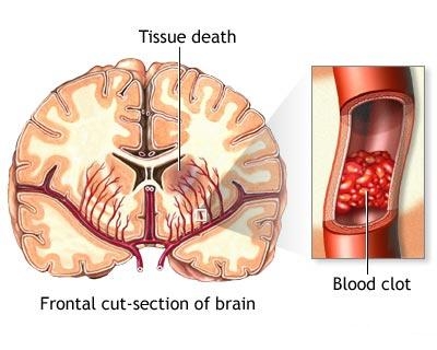 poza despre infarctul cerebral